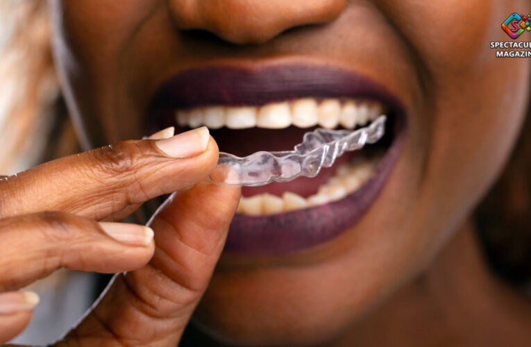 3 Things to Be Aware of When Getting Clear Aligners